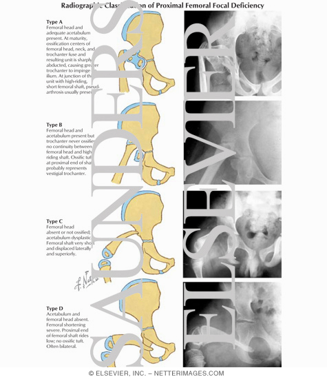 Watermarked preview of labeled image: Radiographic Classification of Proximal Femoral Focal Deficiency
