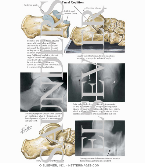Watermarked preview of labeled image: Tarsal Coalition