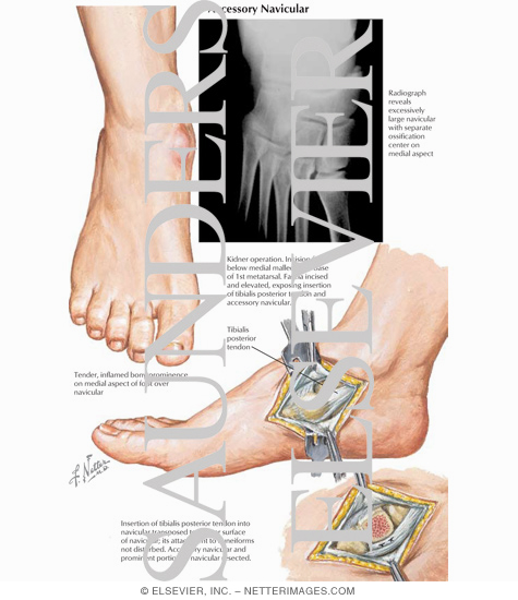 Accessory Navicular