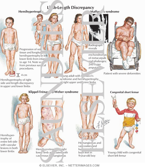 Limb-Length Discrepancy