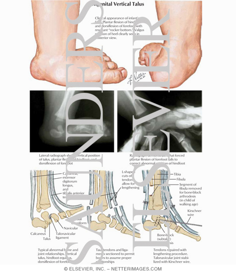 Watermarked preview of labeled image: Congenital Vertical Talus