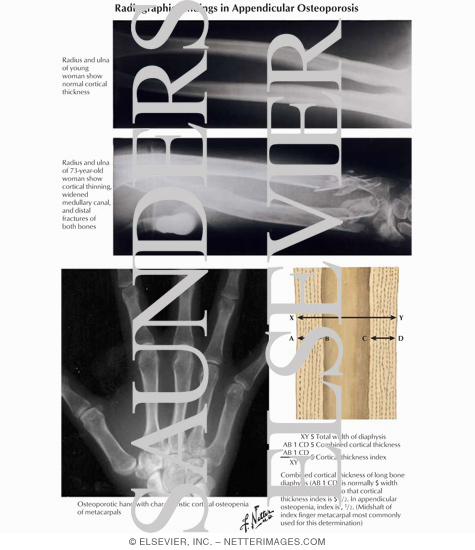 Radiographic Findings in Appendicular Osteoporosis