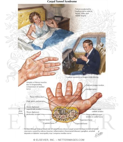 Watermarked preview of labeled image: Carpal Tunnel Syndrome