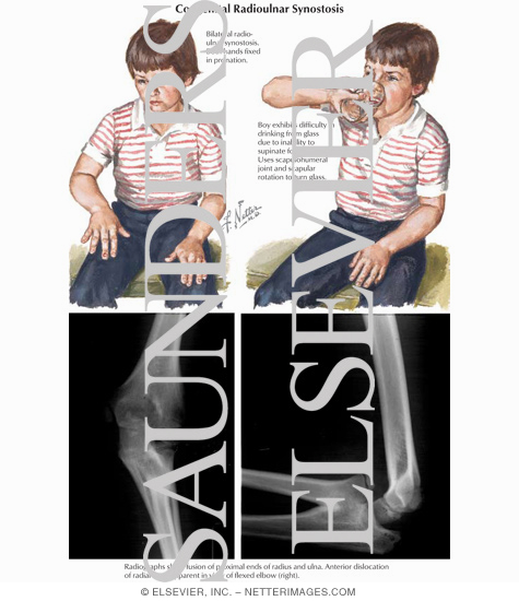 Congenital Radioulnar Synostosis
