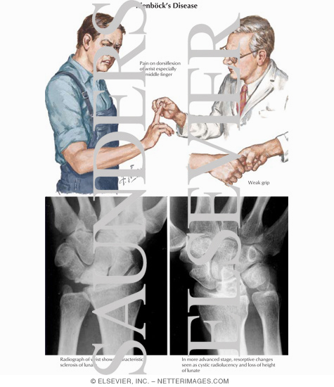 Watermarked preview of labeled image: Kienbock's Disease