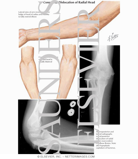 Watermarked preview of labeled image: Congenital Dislocation of Radial Head