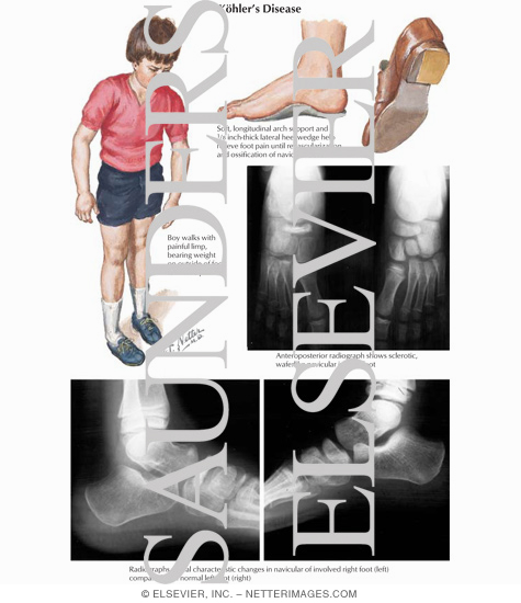 Watermarked preview of labeled image: Kohler's Disease I