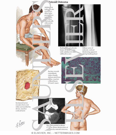 Osteoid Osteoma