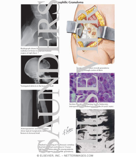 Watermarked preview of labeled image: Eosinophilic Granuloma