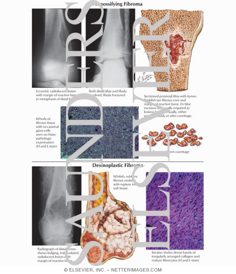 Watermarked preview of labeled image: Nonossifying Fibroma
Desmoplastic Fibroma