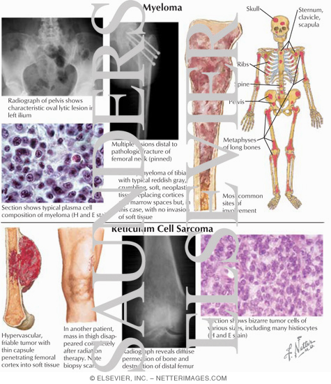 Myeloma, Reticulum-Cell Sarcoma