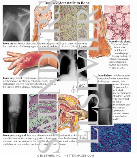 Watermarked preview of labeled image: Tumors Metastatic to Bone