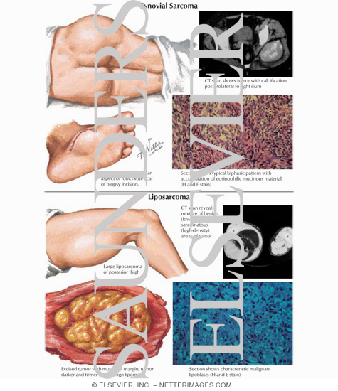 Synovial Sarcoma, Liposarcoma