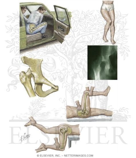 Posterior Dislocation of Hip