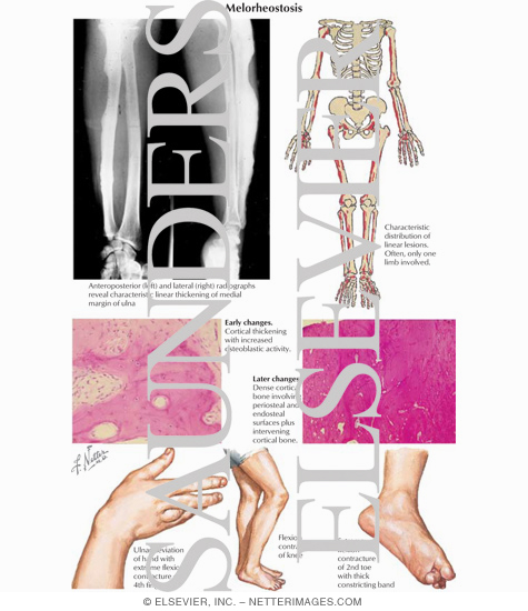 Watermarked preview of labeled image: Melorheostosis