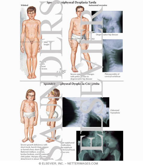 Spondyloepephyseal Dysplasia Tarda