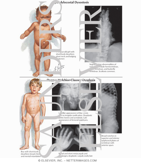 Spondylocostal Dysostosis