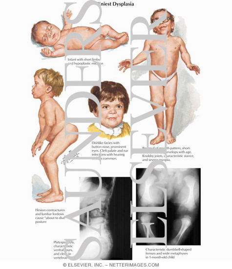 Kniest Dysplasia
