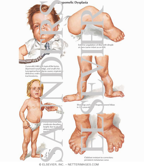 Campomelic Dysplasia