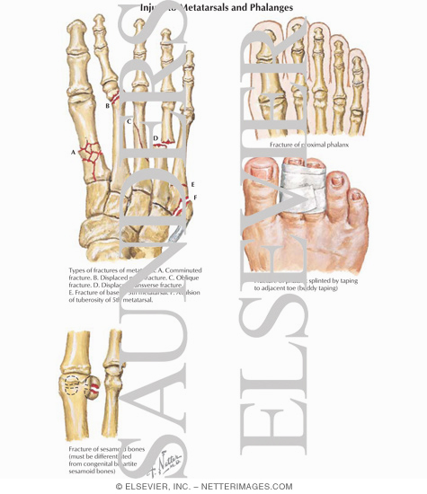 Injury to Metatarsals and Phalanges