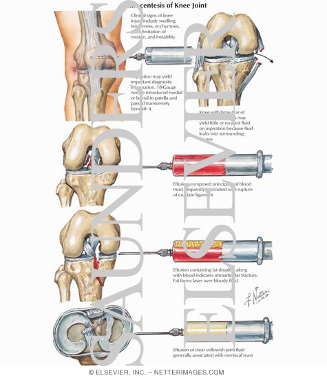 Arthrocentesis of Knee Joint