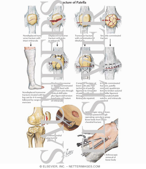 Fracture of Patella
Trauma of the Leg and Knee