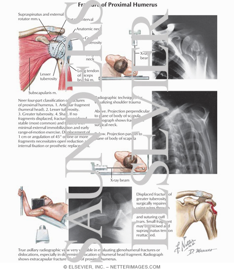Fracture of Proximal Humerus