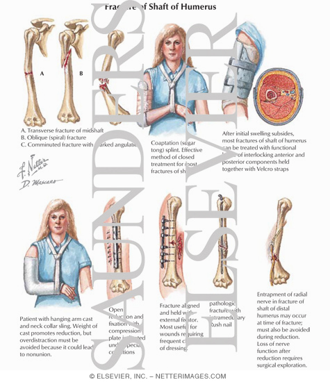 Watermarked preview of labeled image: Fracture of Shaft of Humerus