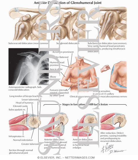 Watermarked preview of labeled image: Anterior Dislocation of Glenohumeral Joint