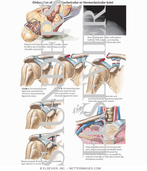 Watermarked preview of labeled image: Dislocation of Acromioclavicular or Sternoclavicular Joint