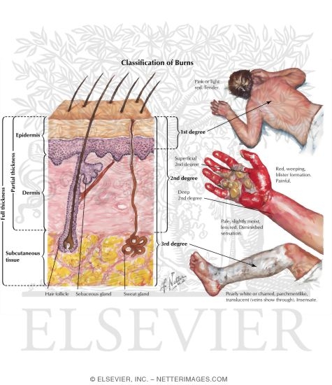 Classification of Burns