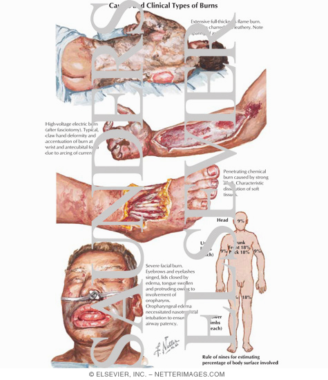 Watermarked preview of labeled image: Causes and Clinical Types of Burns