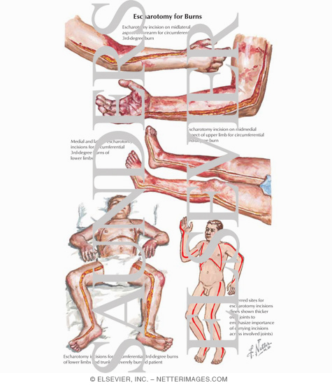 Escharotomy for Burns