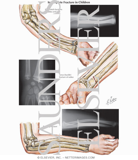 Incomplete Fracture in Children