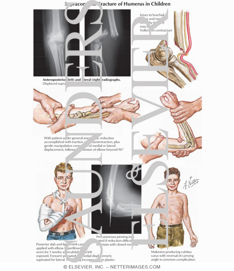 Supracondylar Fracture of Humerus in Children