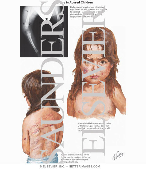 Watermarked preview of labeled image: Fracture in Abused Children
