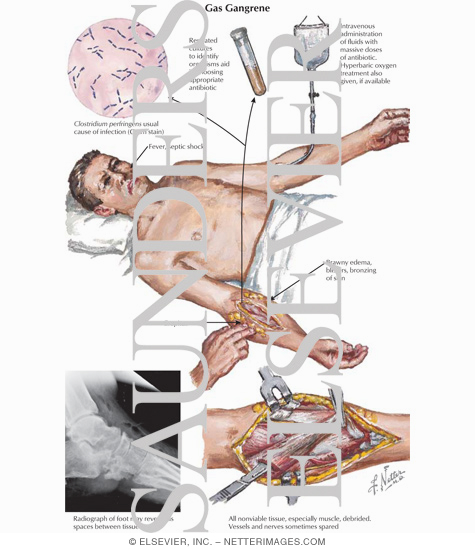 Gas Gangrene