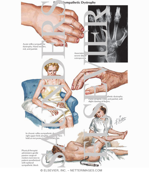 Reflex Sympathetic Dystrophy