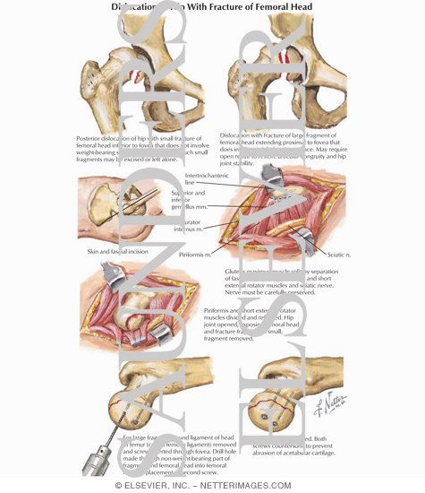 Watermarked preview of labeled image: Dislocation of Hip with Fracture of Femoral Head