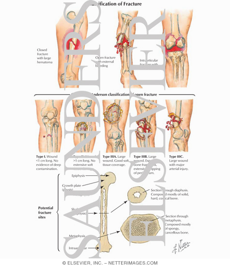 Watermarked preview of labeled image: Classification of Leg and Knee Fracture