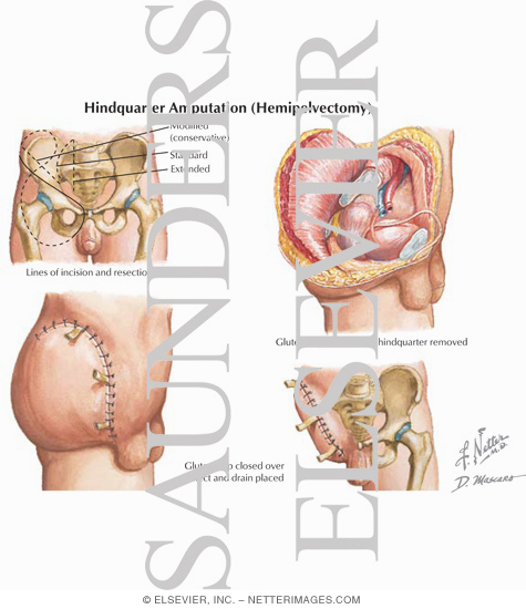 Hindquarter Amputation (Hemipelvectomy)