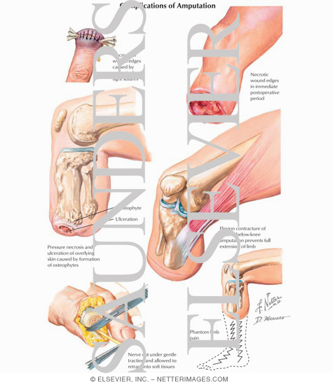 Complications of Amputation