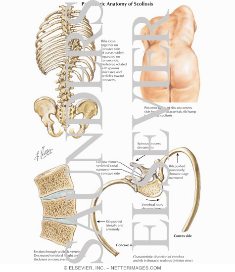 Pathologic Anatomy of Scoliosis