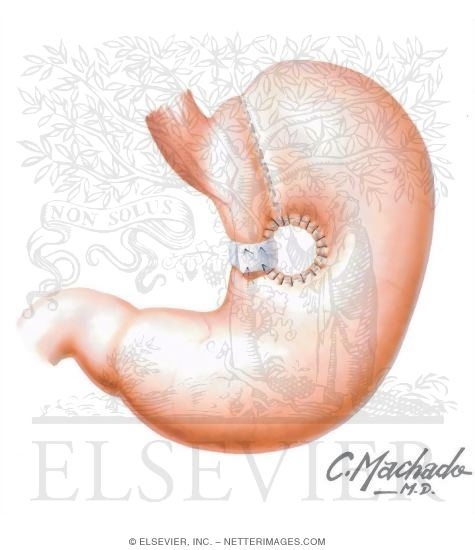 Watermarked preview of unlabeled image: Gastric Stapling (Vertical Banded Gastroplasty)