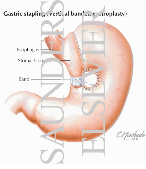 Gastric Stapling (Vertical Banded Gastroplasty)