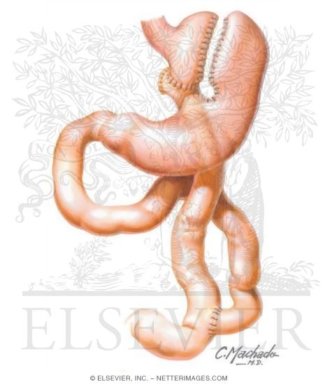Gastric Bypass (Roux-en-Y)