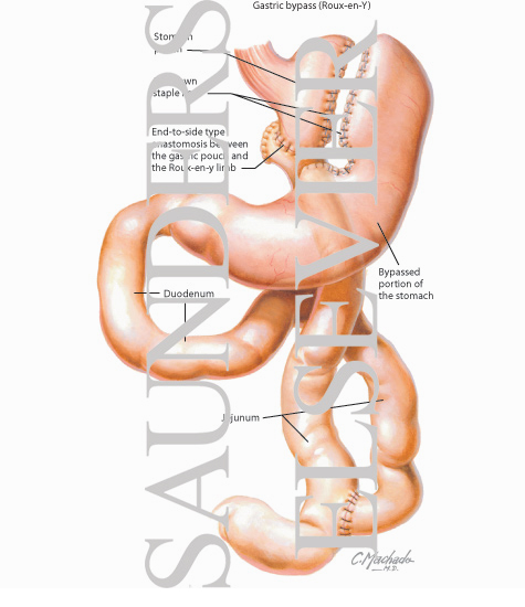 Watermarked preview of labeled image: Gastric Bypass (Roux-en-Y)