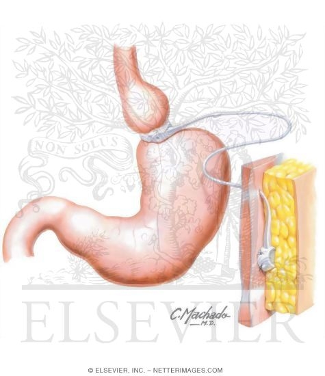 Watermarked preview of unlabeled image: Laparoscopic Adjustable Gastric Banding