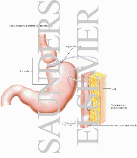 Watermarked preview of labeled image: Laparoscopic Adjustable Gastric Banding
