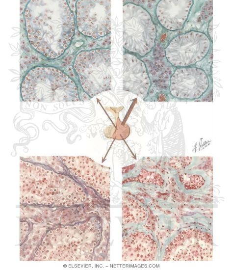 Watermarked preview of unlabeled image: Testicular Failure VI - Gametogenic Failure